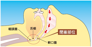 睡眠時無呼吸症候群写真