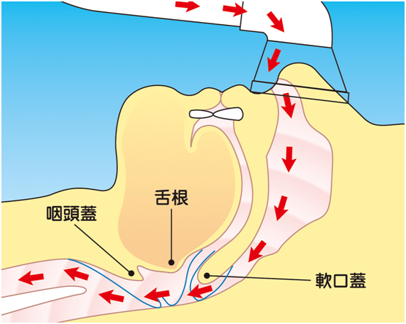 睡眠時無呼吸症候群写真